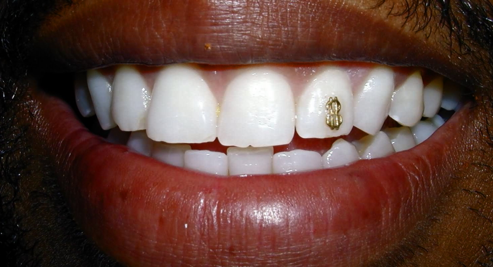 crackled teeth