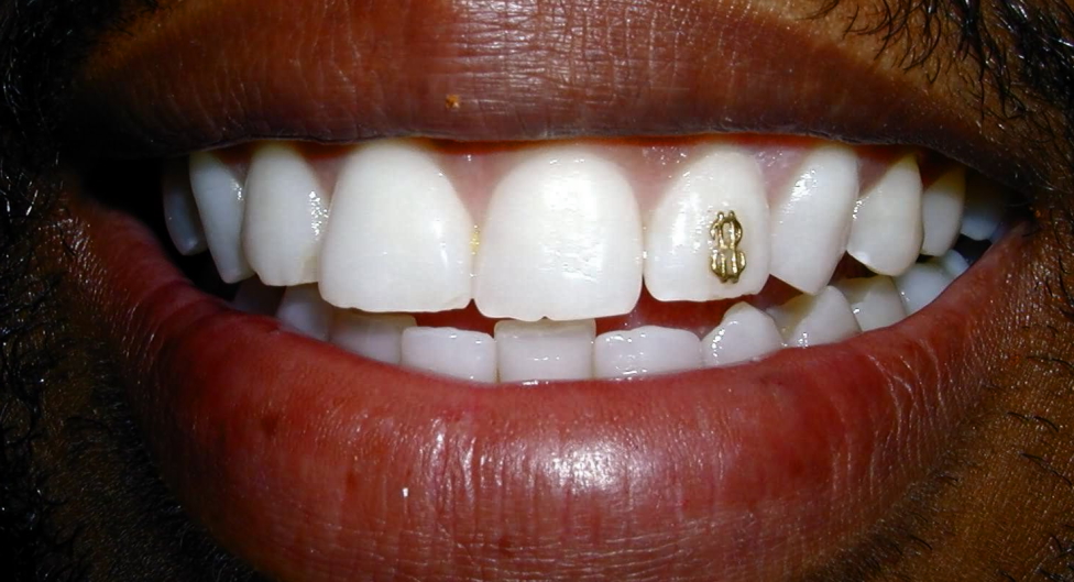 crackled teeth
